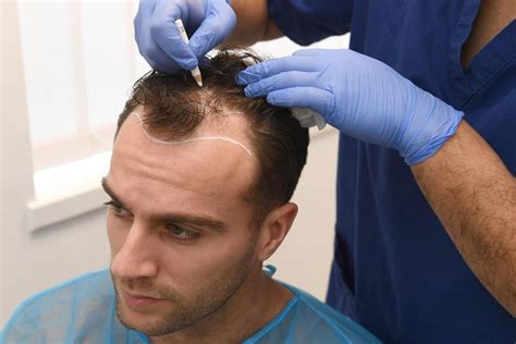 best hair transplant clinics turkey